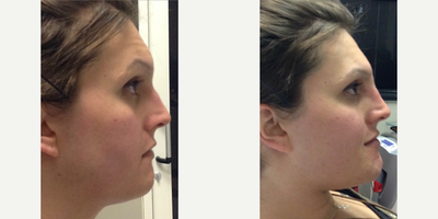 Bellafill before and after photo