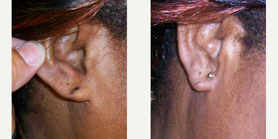Earlobe Repair before and after photo