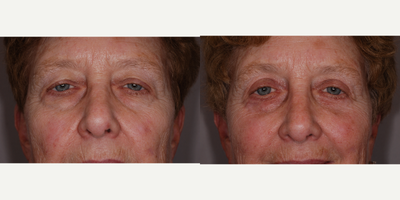 Eyelid Surgery before and after photo