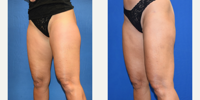 Liposuction before and after photo