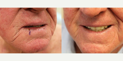 YAG Laser before and after photo