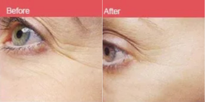 CO2 Laser before and after photo