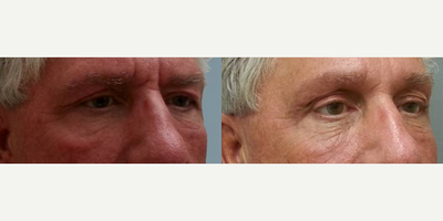 Eyelid Surgery before and after photo