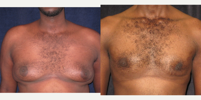 Gynecomastia Surgery before and after photo