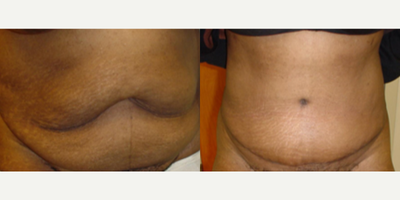 Tummy Tuck before and after photo
