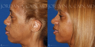 African American Rhinoplasty before and after photo