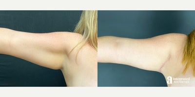 Arm Lift before and after photo