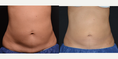 CoolSculpting before and after photo