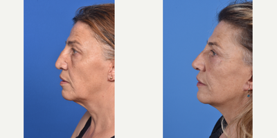 Facelift before and after photo