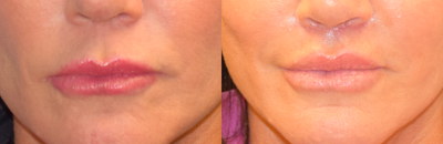 Lip Lift before and after photo