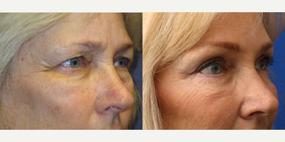 Ultherapy before and after photo