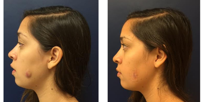 Mole Removal before and after photo