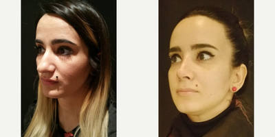 Rhinoplasty before and after photo
