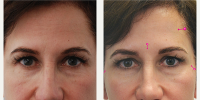 Botox before and after photo