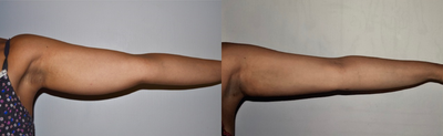 Laser Liposuction before and after photo