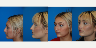 Rhinoplasty before and after photo