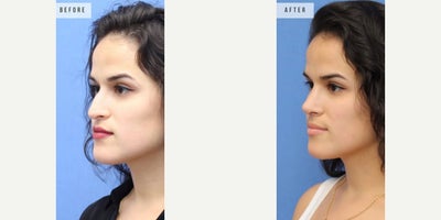 Rhinoplasty before and after photo