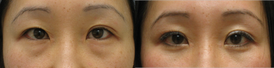 Double Eyelid Surgery before and after photo