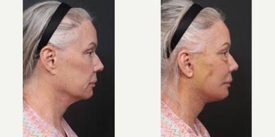 Facelift Revision before and after photo