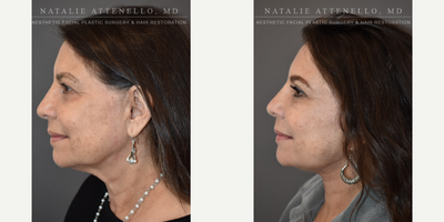 Lower Facelift before and after photo