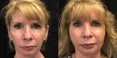 Thread Lift before and after photo