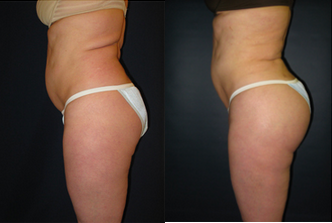 Butt Augmentation before and after photo