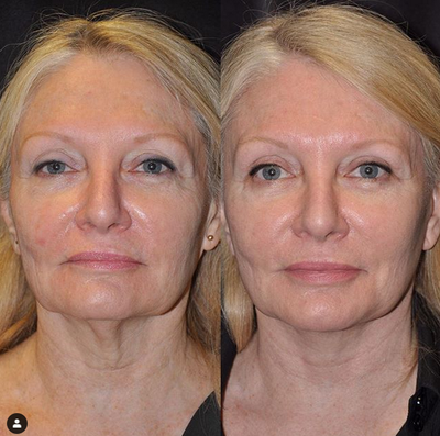 Cheek Lift before and after photo