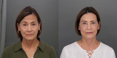 Deep Plane Facelift before and after photo