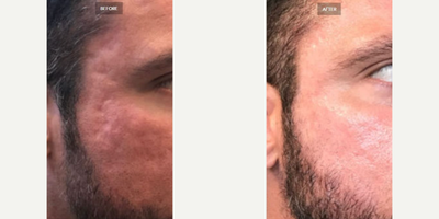 Dermal Fillers before and after photo