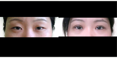 Double Eyelid Surgery before and after photo