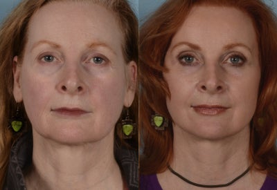 Facelift before and after photo
