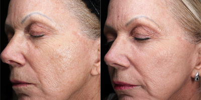 ProFractional Laser before and after photo