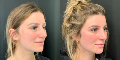Septoplasty before and after photo