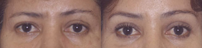 Brow Lift before and after photo