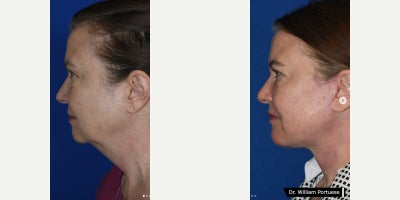 Chin Implant before and after photo