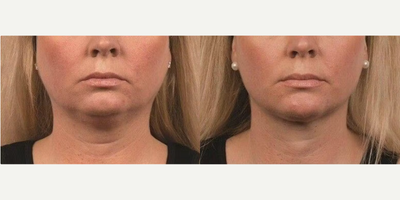 CoolSculpting before and after photo