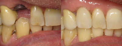 Dental Implants before and after photo