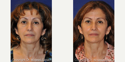 Eyelid Surgery before and after photo