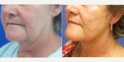 Neck Lift before and after photo