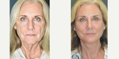 Neck Lift before and after photo