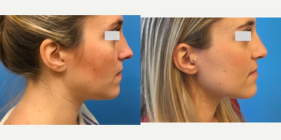 Rhinoplasty before and after photo