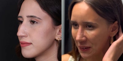 Rhinoplasty before and after photo