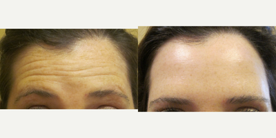 Botox before and after photo