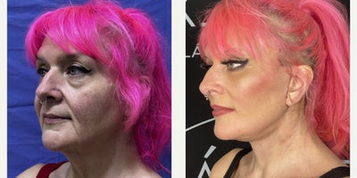 Deep Plane Facelift before and after photo
