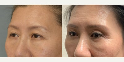 Eyelid Surgery before and after photo