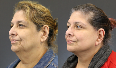 Facelift before and after photo