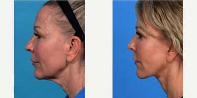 Facelift before and after photo
