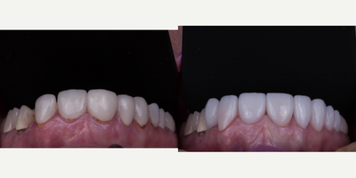 Porcelain Veneers before and after photo