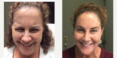 Xeomin before and after photo