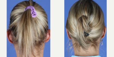 Ear Surgery before and after photo